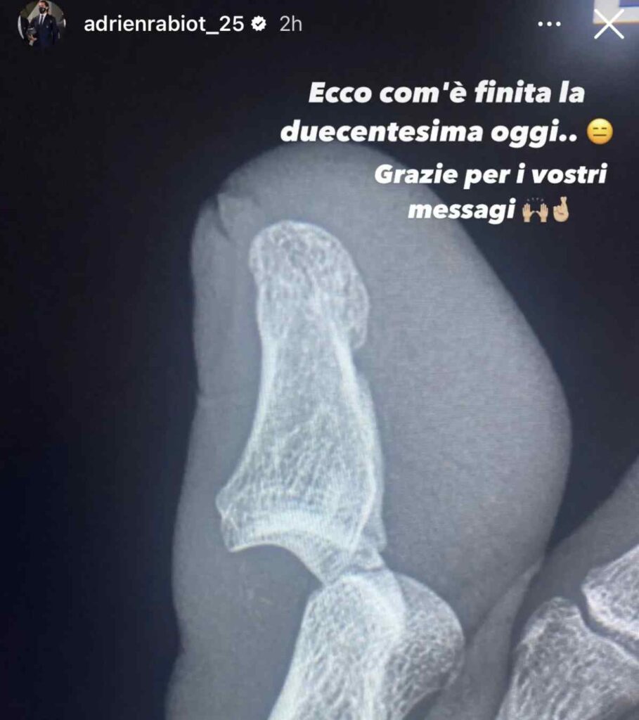 Rabiot preoccupa i tifosi: la foto del piede dopo l'infortunio